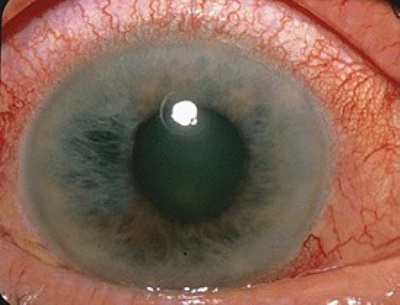 Чем страшна глаукома?