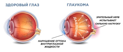 Катаракта и глаукома - одновременное лечение (капли, операция)