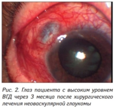 Чем опасна глаукома?