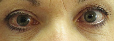 Насколько опасна глаукома в старости?