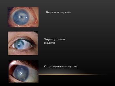 Глаукома глаза. Причины, симптомы, лечение глаукомы народными средствами