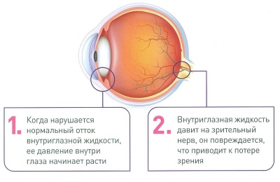Глаукома: причины заболевания, основные симптомы, лечение и профилактика