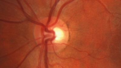 Глаукома и катаракта: как они взаимосвязаны