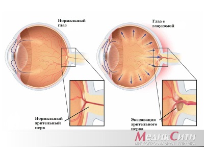Глаукома нормального давления